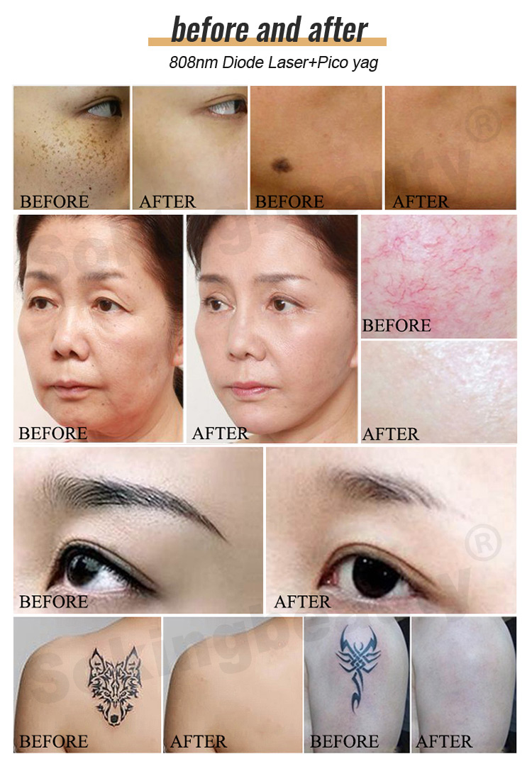 808NM Diode Laser And YAG Laser Machine